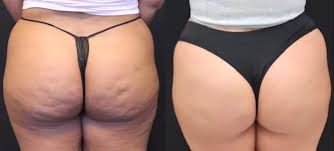 Omni Aesthetics Introduces Groundbreaking Aveli™ Cellulite Solution for Smoother, Firmer Skin